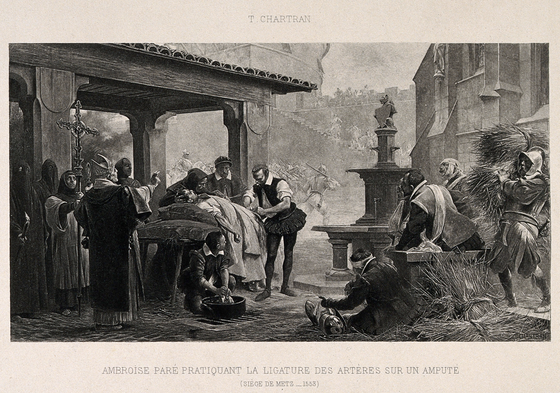 Ambroise Paré and early vessel ligation